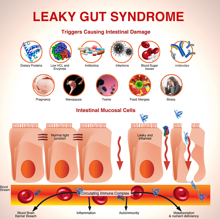 Leaky Gut Syndrome Leaky Gut Syndrome